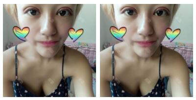 朱清武醫(yī)生切開雙眼皮案例分享 朱清武醫(yī)生切開雙眼皮案例分享