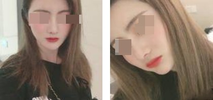 術(shù)后照片 術(shù)后照片