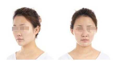 蘭州美月整形美容醫(yī)院文輝才醫(yī)生做鼻綜合整形效果怎么樣？附鼻綜合案例