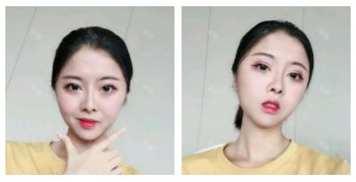 深圳嶺南醫(yī)院整形醫(yī)生丁祖鑫做假體豐太陽穴案例效果對(duì)比圖 深圳嶺南醫(yī)院整形醫(yī)生丁祖鑫做假體豐太陽穴案例效果對(duì)比圖