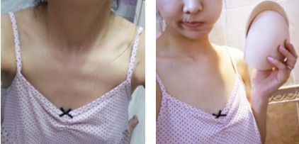 沈陽杏林整形美容醫(yī)院崔昌墉醫(yī)生做假體隆胸技術怎么樣？附案例