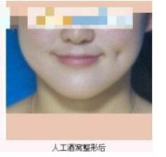 德州市第二人民醫(yī)院燒傷美容整形科張波濤醫(yī)生做酒窩成形術(shù)怎么樣？