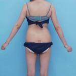 青島銘醫(yī)醫(yī)學整形醫(yī)生王殿棟做全身吸脂效果怎么樣？附案例展示