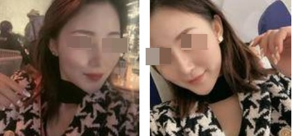 蘭州美月整形美容醫(yī)院文輝才醫(yī)生做鼻綜合整形效果怎么樣？附鼻綜合案例