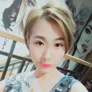 雙眼皮手術(shù)第二十天