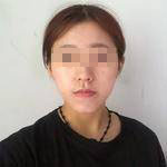 做完埋線提升后，松弛的臉蛋拜拜了