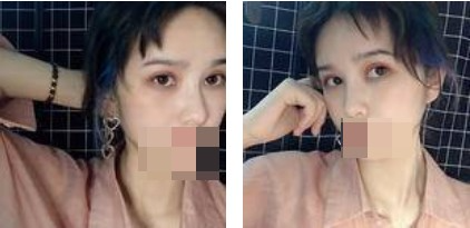 做了切開雙眼皮手術(shù)，才發(fā)現(xiàn)自己原來可以這么美！