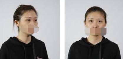 激光祛眼袋術(shù)前照片