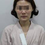 做完自體脂肪豐面頰后，我的面部比例更加完美了呢