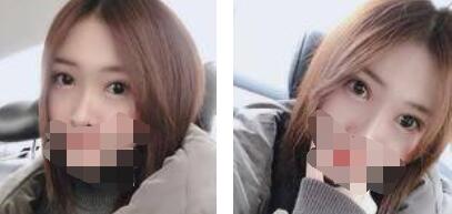 激光祛眼袋恢復(fù)過程