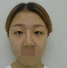 做了全切雙眼皮不僅外表變美了，內(nèi)心也更加自信了