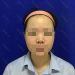 玻尿酸隆鼻讓我的鼻子更加“挺翹”