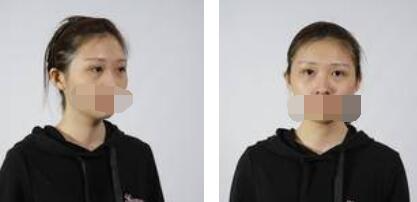 沒(méi)有了眼袋困擾，身體和心態(tài)都年輕了十歲