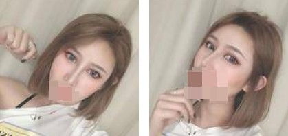 鼻綜合+眼綜合整形，讓我美的更自然，再也不用p圖了