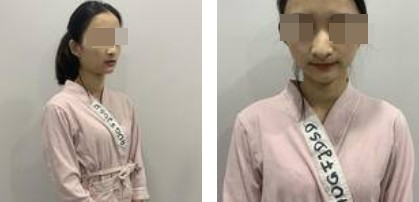 美麗自信的生活從自體軟骨隆鼻開始