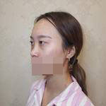 隆鼻+雙眼皮手術(shù)讓我成功蛻變，顏值達(dá)到巔峰