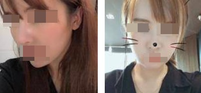 面部吸脂讓你做一個更受歡迎的精致“小臉”的女人