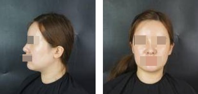 術(shù)前照片 術(shù)前照片