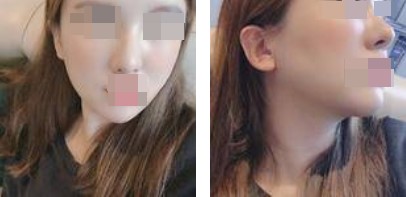 恢復(fù)過(guò)程 恢復(fù)過(guò)程