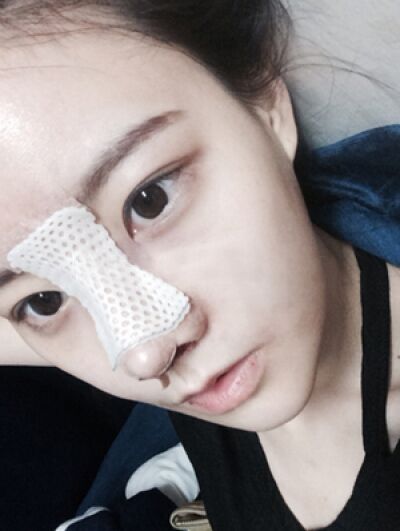 貴陽長江醫(yī)院整形美容中心韓盛斌醫(yī)生做自體脂肪隆鼻+全臉填充案例 貴陽長江醫(yī)院整形美容中心韓盛斌醫(yī)生做自體脂肪隆鼻+全臉填充案例