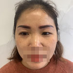 雙眼皮修復(fù)給我重新帶來了自信和面對生活的勇氣