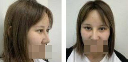 鼻綜合+眼綜合整形，讓我美的更自然，再也不用p圖了