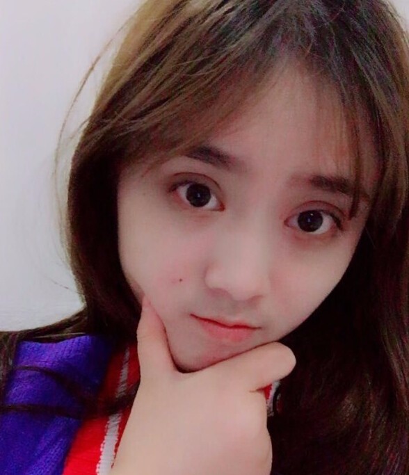 福州愛美爾整形黃林勝雙眼皮案例效果對比圖