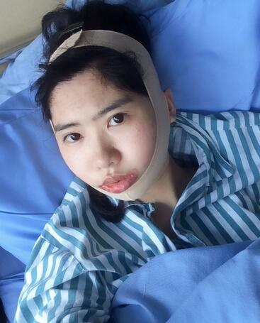 下頜角手術第四天 下頜角手術第四天