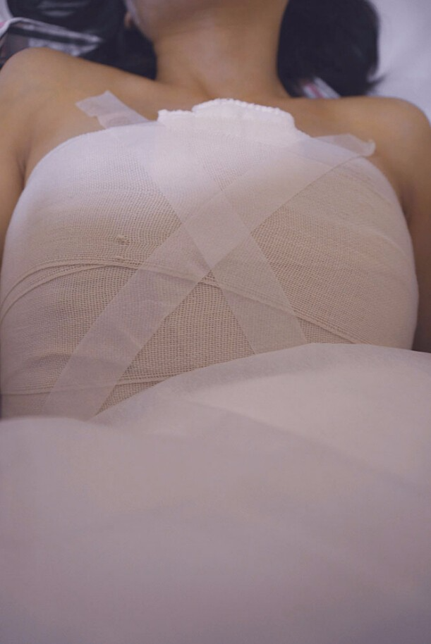 邯鄲凱潤婷整形醫(yī)生馬戰(zhàn)勝做自體脂肪隆胸怎么樣？ 附馬戰(zhàn)勝自體脂肪隆胸案例