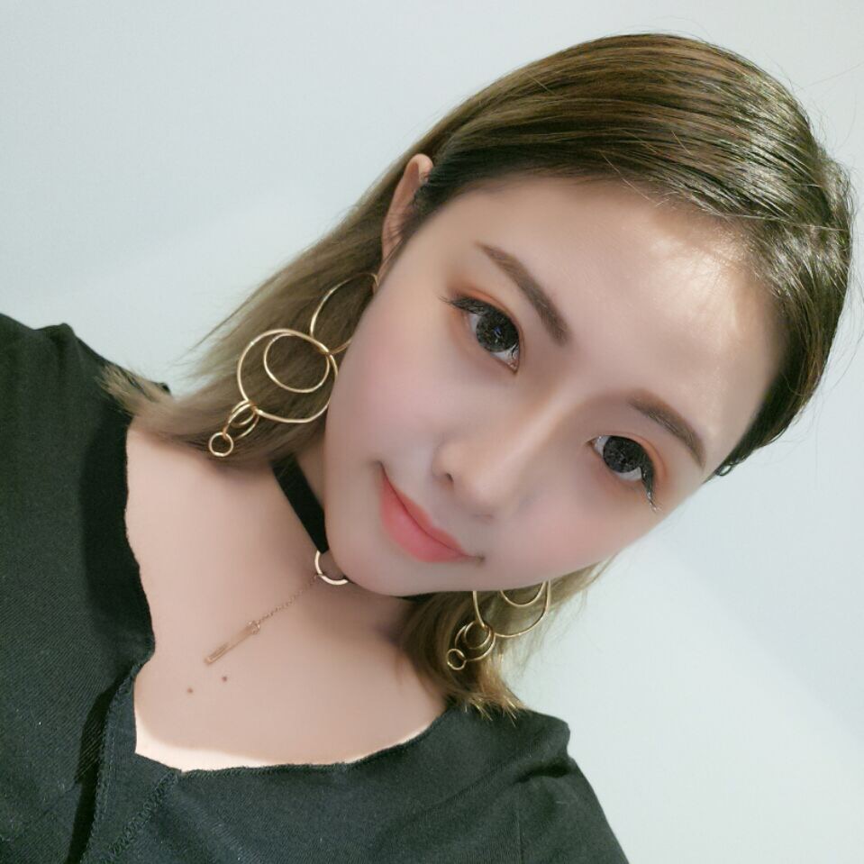 整形醫(yī)生徐長(zhǎng)亮做切開雙眼皮案例效果對(duì)比圖