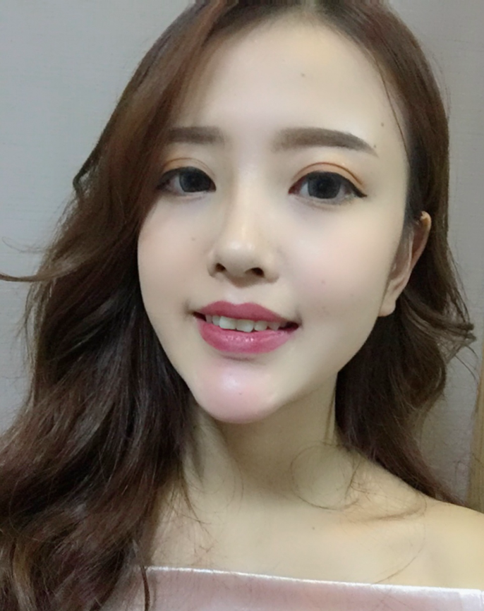 成都漢密爾頓美容醫(yī)院做牙齒矯正怎么樣？成都漢密爾頓牙齒矯正案例