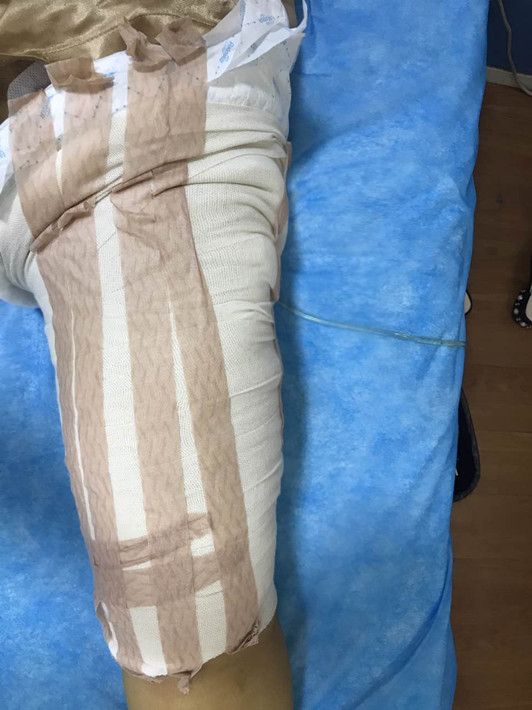 廣州軍頤醫(yī)院整形美容中心石建薇醫(yī)生腰腹吸脂真實案例對比圖 廣州軍頤醫(yī)院整形美容中心石建薇醫(yī)生腰腹吸脂真實案例對比圖