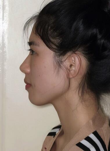 術前側面: 術前側面: