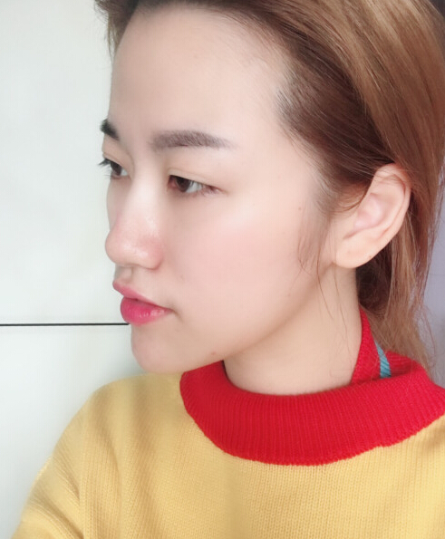 成都藝星陳遠(yuǎn)琨醫(yī)生注射肉毒素瘦臉效果案例對(duì)比圖 成都藝星陳遠(yuǎn)琨醫(yī)生注射肉毒素瘦臉效果案例對(duì)比圖