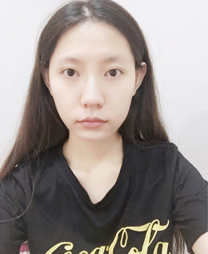  濟(jì)南安美醫(yī)療整形醫(yī)生李思思做下頜角整形怎么樣？李思思下頜角整形案例