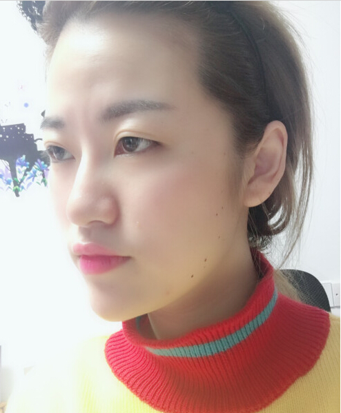 成都藝星陳遠(yuǎn)琨醫(yī)生注射肉毒素瘦臉效果案例對(duì)比圖 成都藝星陳遠(yuǎn)琨醫(yī)生注射肉毒素瘦臉效果案例對(duì)比圖