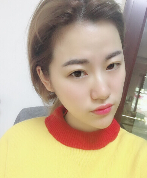 成都藝星陳遠(yuǎn)琨醫(yī)生注射肉毒素瘦臉效果案例對(duì)比圖 成都藝星陳遠(yuǎn)琨醫(yī)生注射肉毒素瘦臉效果案例對(duì)比圖