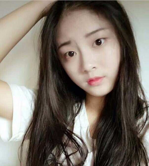 福州愛美爾整形黃林勝雙眼皮案例效果對比圖