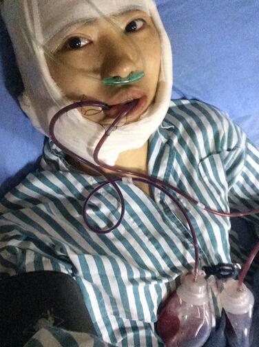 下頜角手術當天 下頜角手術當天