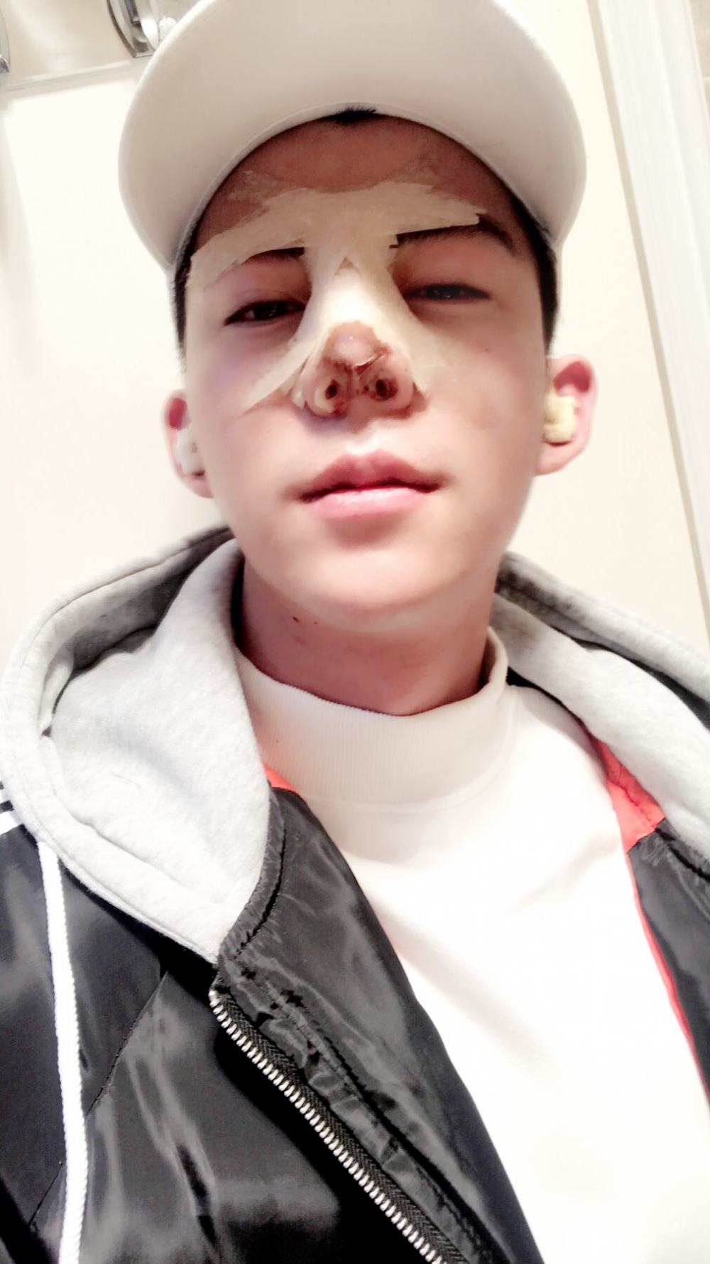 濟(jì)寧名美醫(yī)療整形醫(yī)生李唯少假體隆鼻+耳軟骨墊鼻尖真實(shí)案例效果對比圖