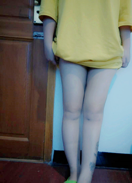 廣州軍頤醫(yī)院整形美容中心石建薇醫(yī)生腰腹吸脂真實案例對比圖 廣州軍頤醫(yī)院整形美容中心石建薇醫(yī)生腰腹吸脂真實案例對比圖