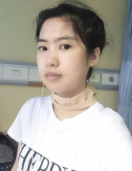 下頜角手術第八天 下頜角手術第八天