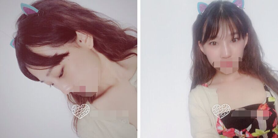 珠海艾瑞醫(yī)療美容醫(yī)院余昌盛醫(yī)生做耳軟骨隆鼻真實(shí)案例分享