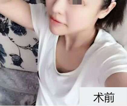 深圳博美整形醫(yī)生劉超做自體脂肪隆胸怎么樣？自體脂肪隆胸案例