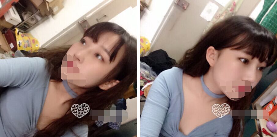 珠海艾瑞醫(yī)療美容醫(yī)院余昌盛醫(yī)生做耳軟骨隆鼻真實案例分享