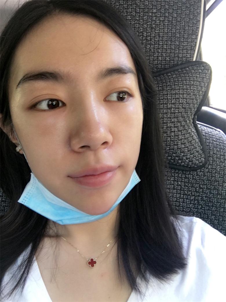 合肥壹加壹整形美容醫(yī)院做祛眼袋效果怎么樣？金大生祛眼袋案例分享