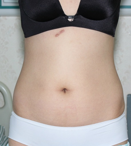 深圳晨曦整形醫(yī)院吉米斯做腰腹吸脂怎么樣？附吉米斯醫(yī)生腰腹吸脂案例