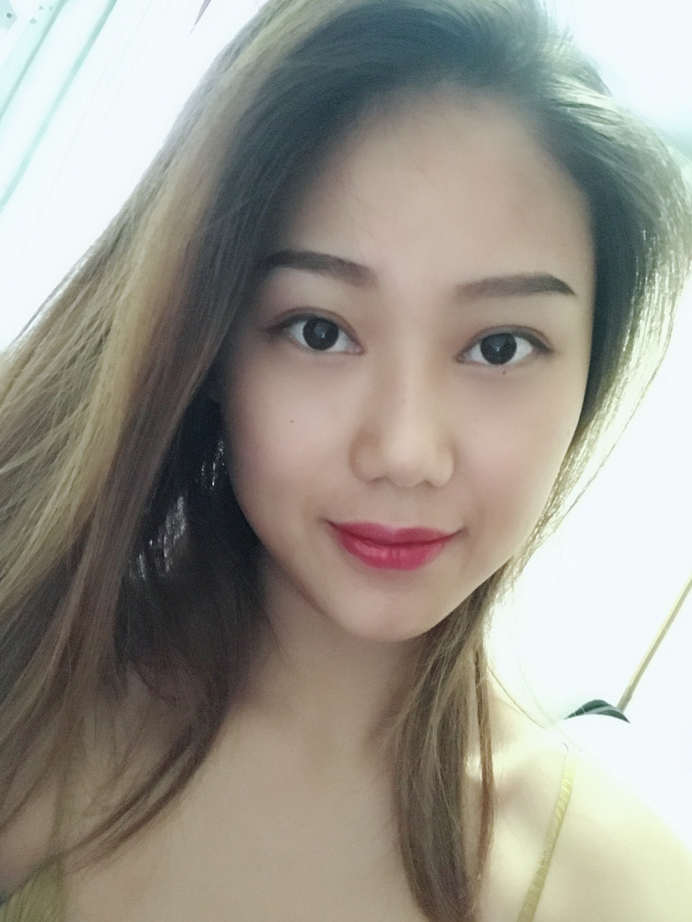 西安藝星埋線提升案例 西安藝星埋線提升案例