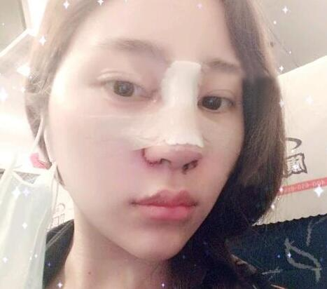 蘇州明基醫(yī)院醫(yī)療美容科做鼻綜合整形怎么樣？蘇州明基鼻綜合整形案例