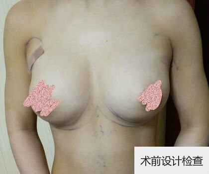 深圳博美整形醫(yī)生劉超做自體脂肪隆胸怎么樣？自體脂肪隆胸案例